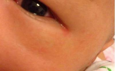 婴儿出生眼睛红
